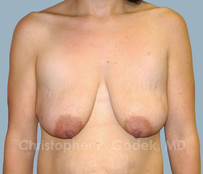 Breast Lift  Before & After Image