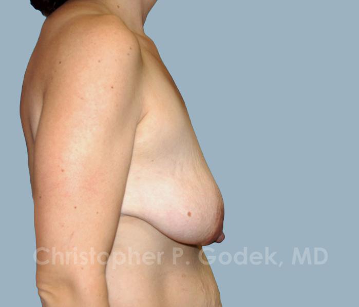 Breast Lift  Before & After Image