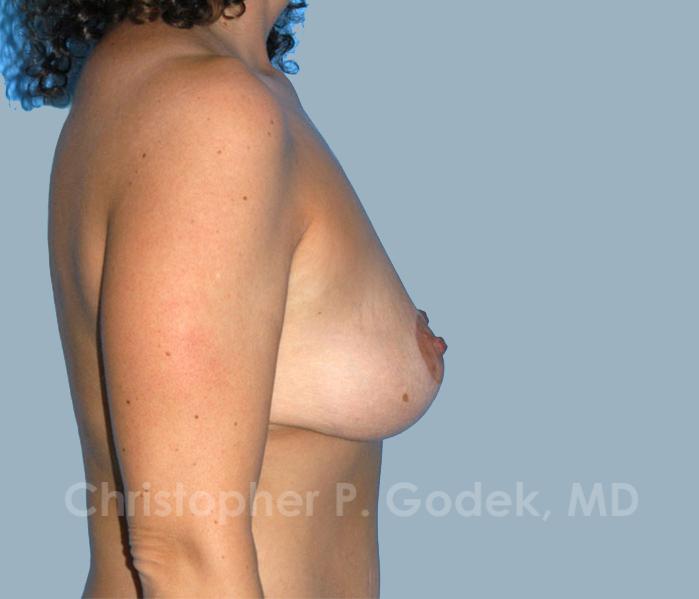 Breast Lift  Before & After Image