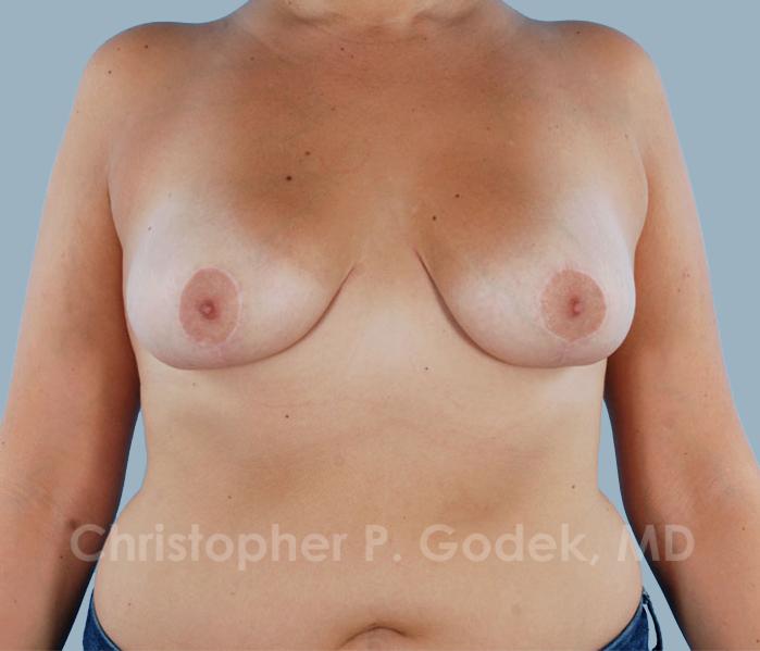 Breast Lift  Before & After Image