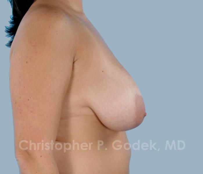 Breast Lift  Before & After Image