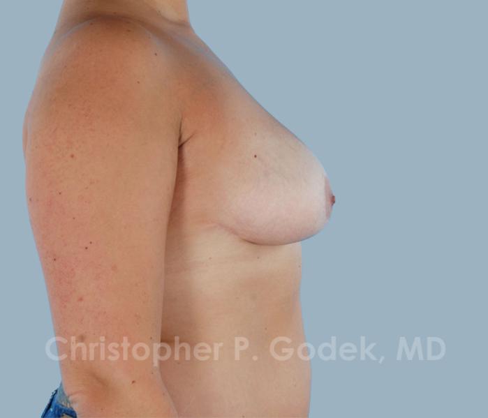 Breast Lift  Before & After Image