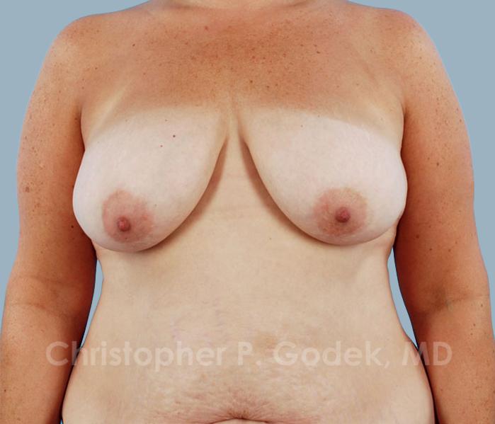 Breast Lift  Before & After Image