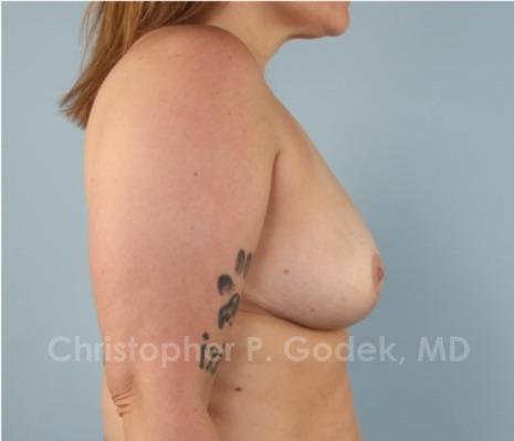 Breast Lift  Before & After Image