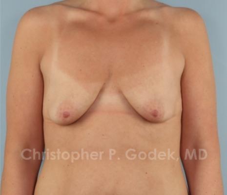 Lift with Implants Before & After Image