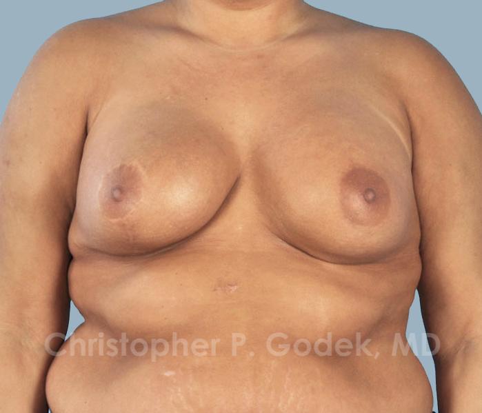 Lift with Implants Before & After Image