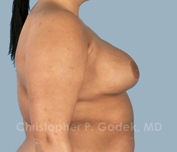 Lift with Implants Before & After Image