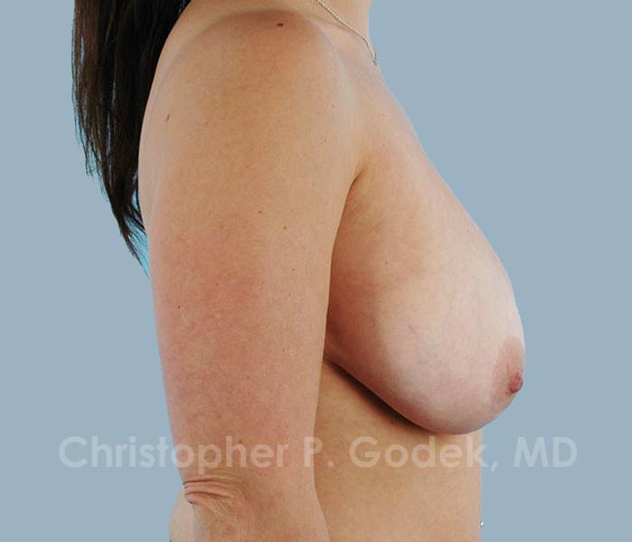 Lift with Implants Before & After Image