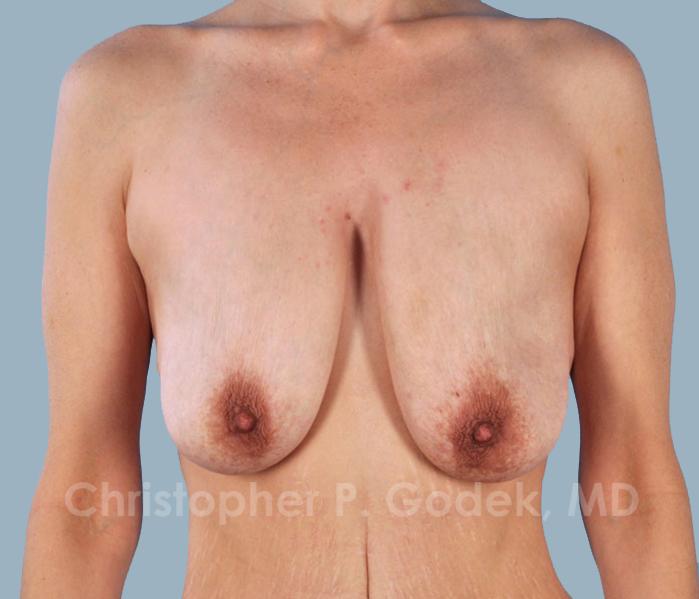 Lift with Implants Before & After Image