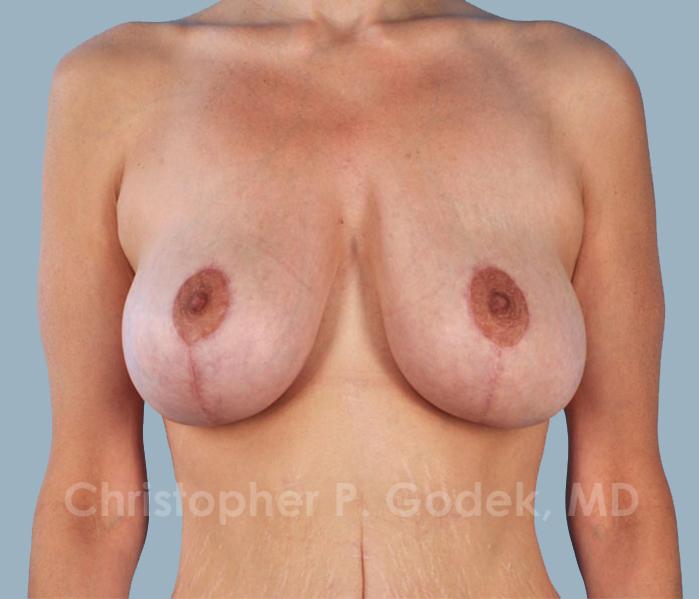 Lift with Implants Before & After Image