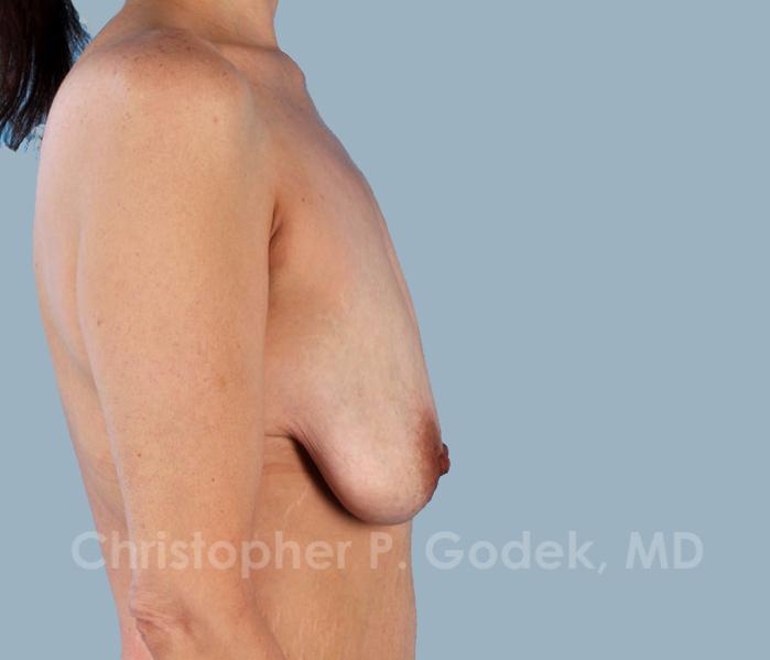 Lift with Implants Before & After Image