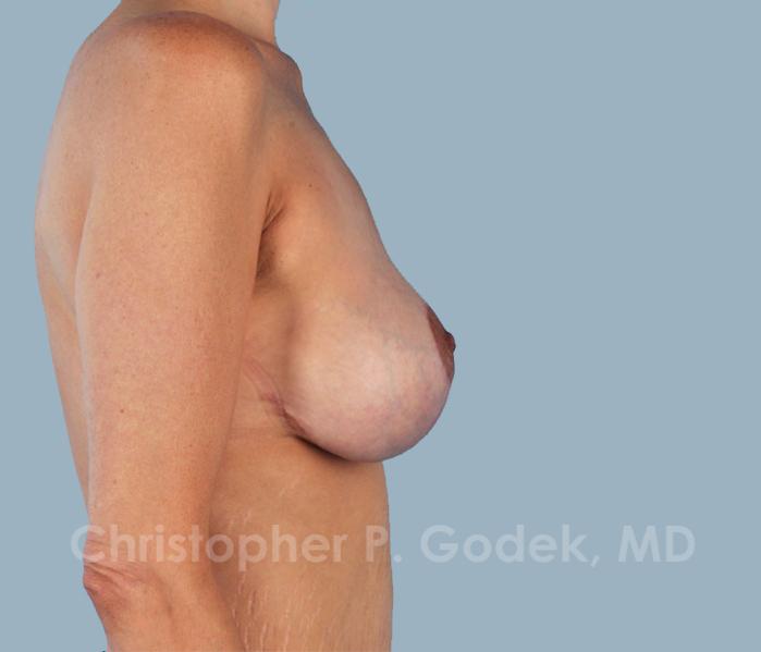 Lift with Implants Before & After Image