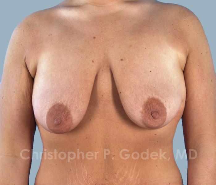 Lift with Implants Before & After Image