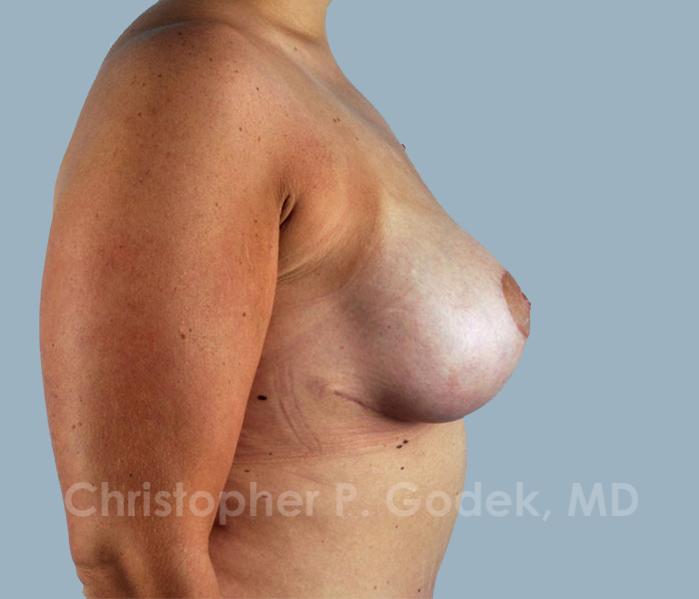 Lift with Implants Before & After Image