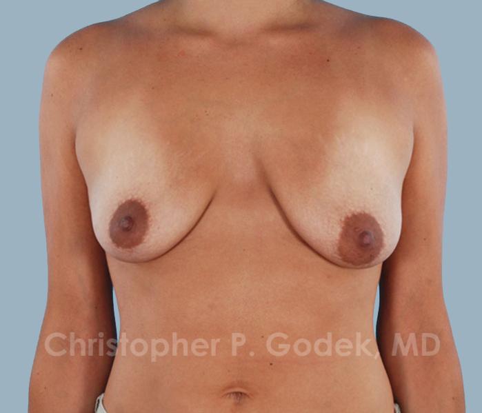 Lift with Implants Before & After Image