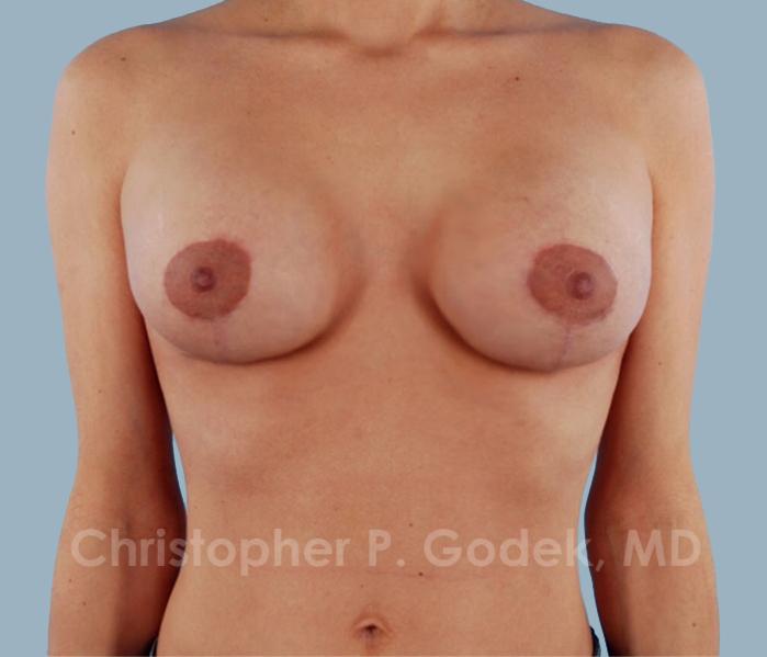 Lift with Implants Before & After Image