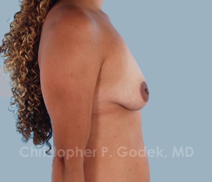 Lift with Implants Before & After Image