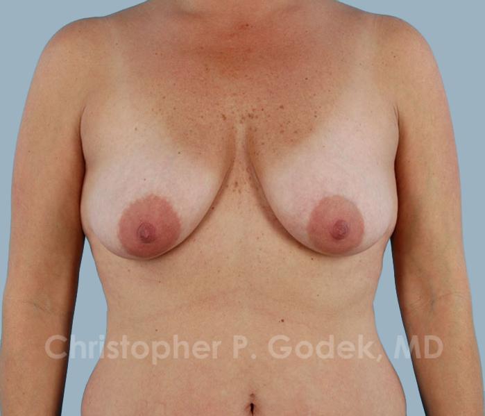 Lift with Implants Before & After Image