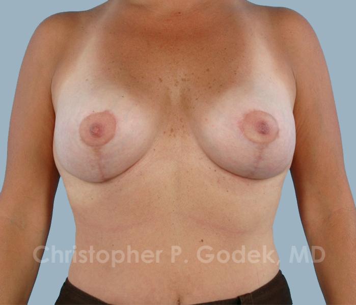 Lift with Implants Before & After Image