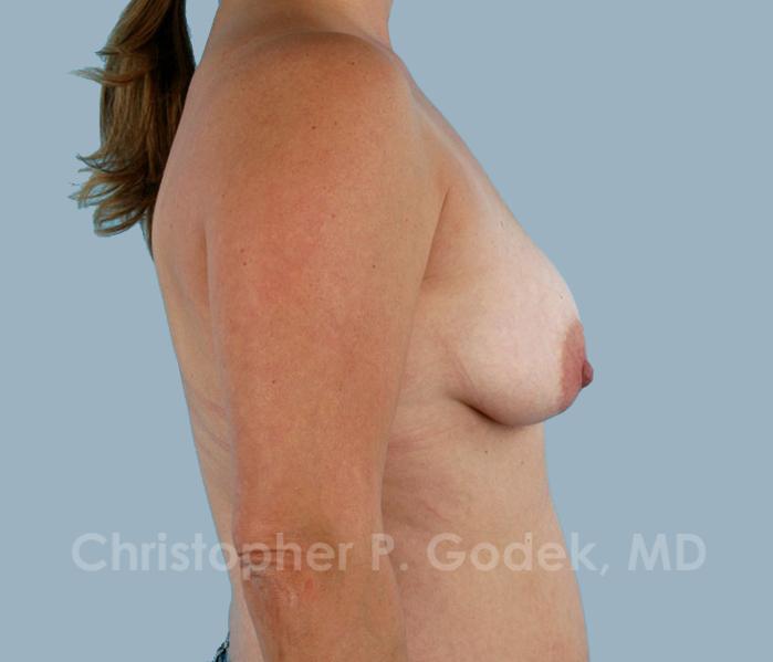 Lift with Implants Before & After Image