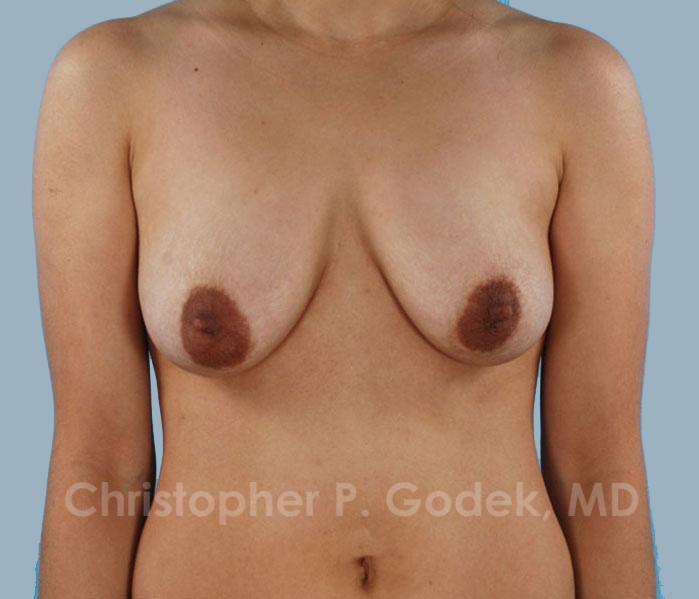 Lift with Implants Before & After Image