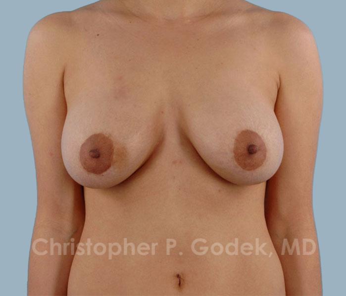 Lift with Implants Before & After Image