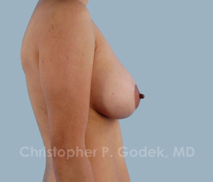 Lift with Implants Before & After Image