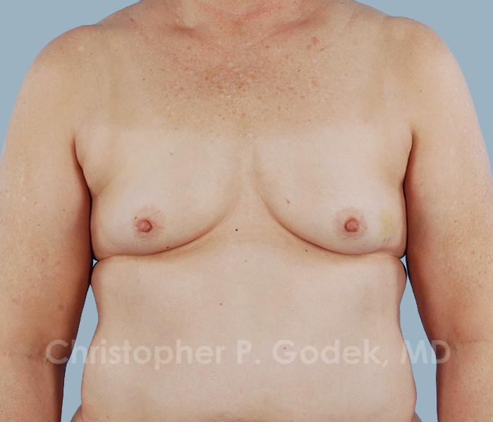 Breast Reconstruction  Before & After Image