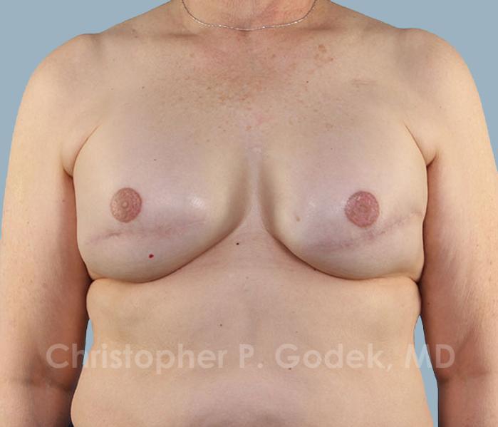 Breast Reconstruction  Before & After Image