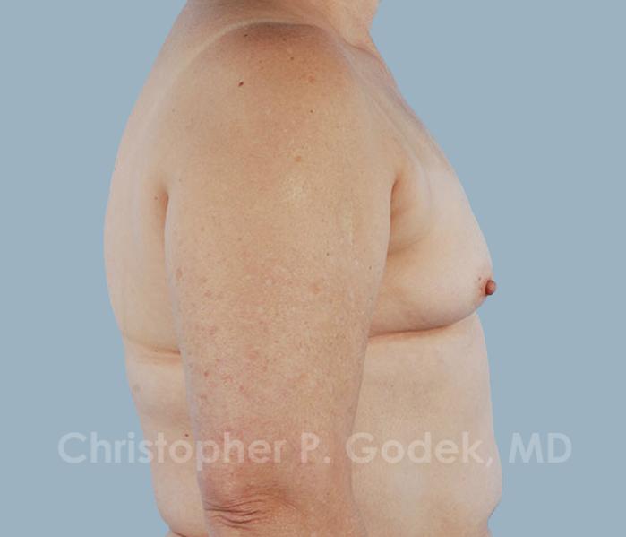 Breast Reconstruction  Before & After Image