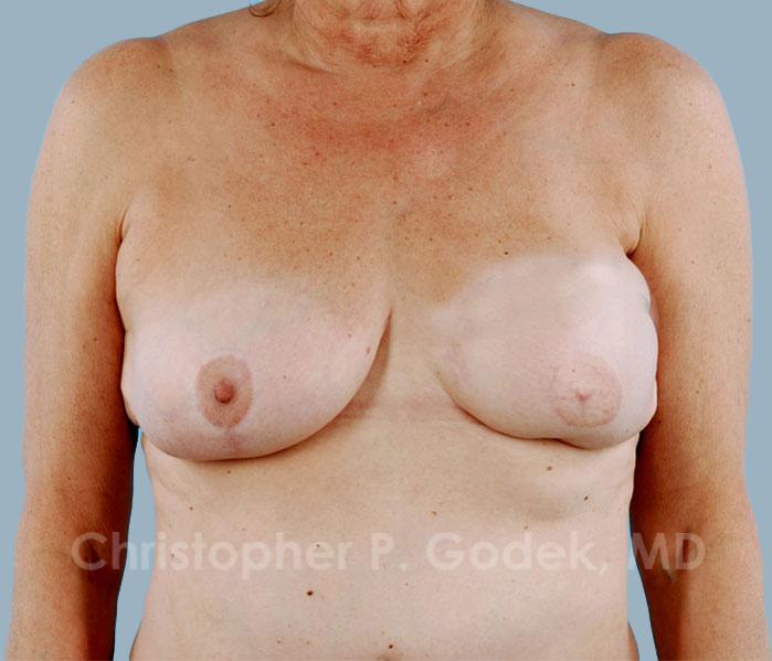 Breast Reconstruction  Before & After Image