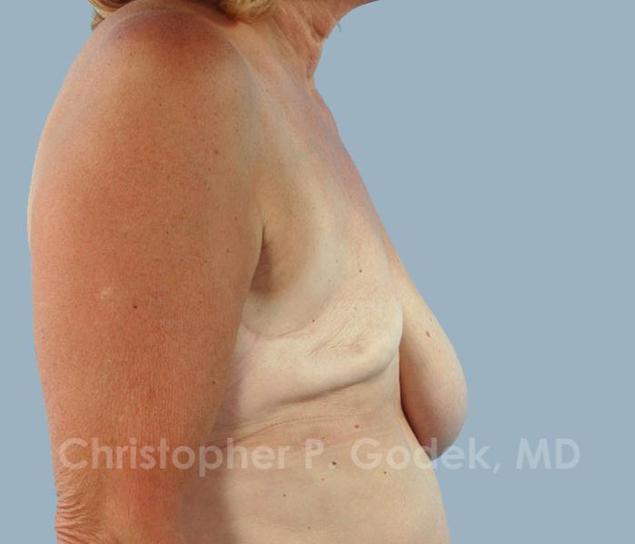 Breast Reconstruction  Before & After Image