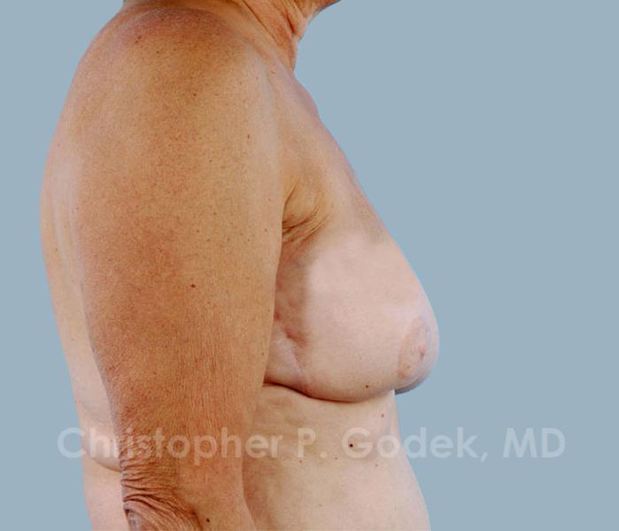 Breast Reconstruction  Before & After Image