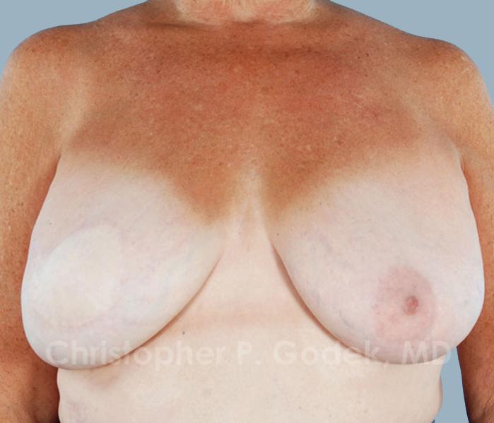 Breast Reconstruction  Before & After Image