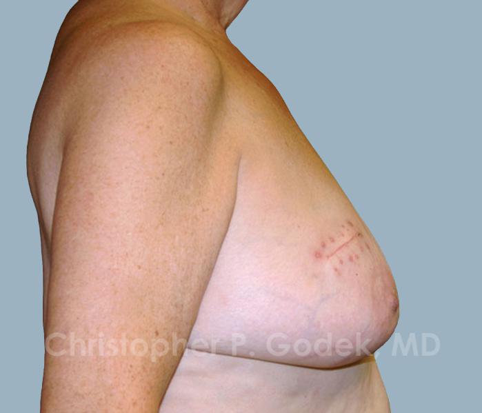 Breast Reconstruction  Before & After Image