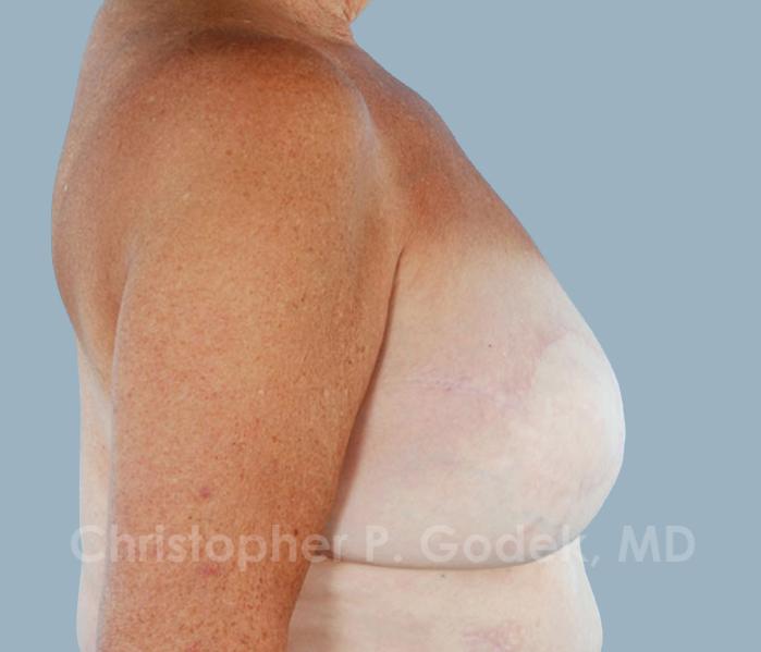 Breast Reconstruction  Before & After Image