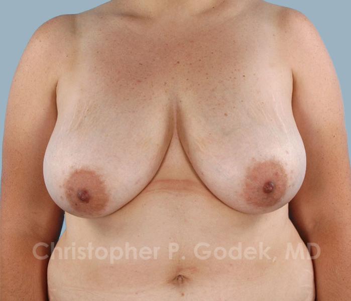 Breast Reconstruction  Before & After Image