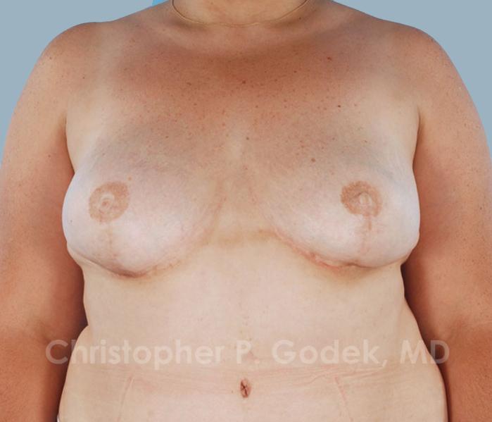 Breast Reconstruction  Before & After Image