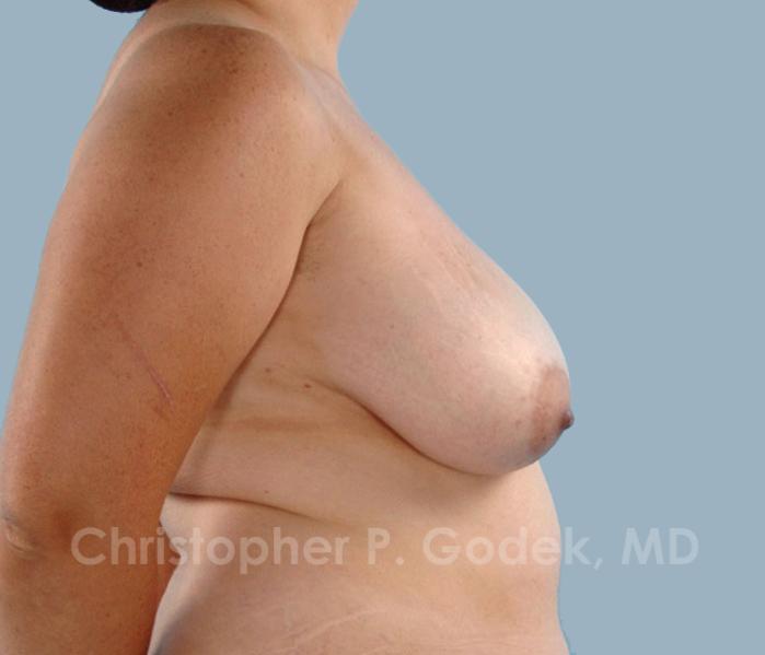 Breast Reconstruction  Before & After Image