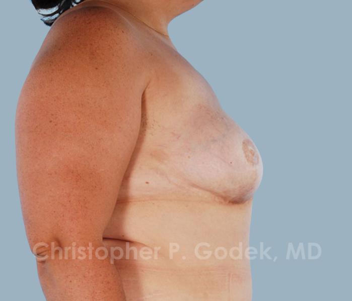 Breast Reconstruction  Before & After Image