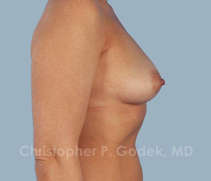 Breast Reconstruction  Before & After Image