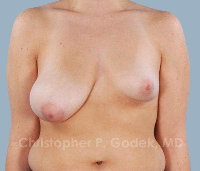 Breast Reduction Before & After Image