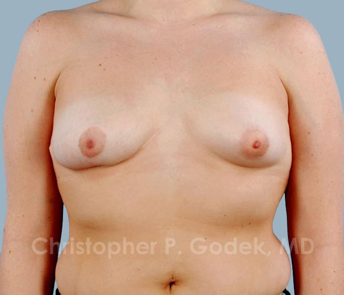 Breast Reduction Before & After Image