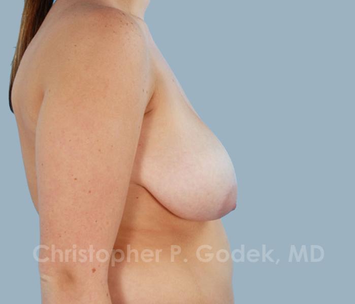 Breast Reduction Before & After Image