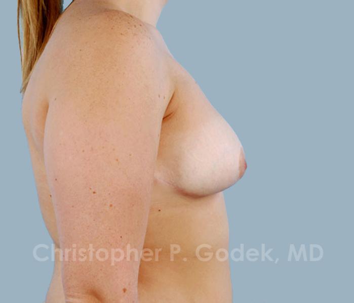 Breast Reduction Before & After Image