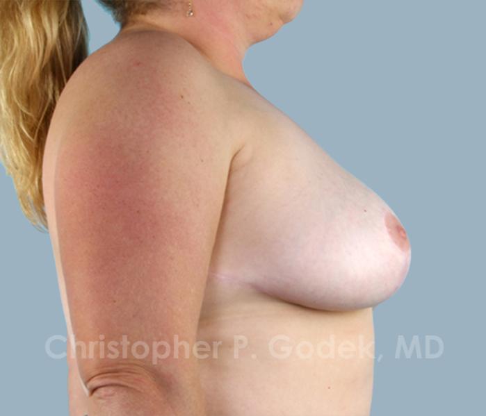 Breast Reduction Before & After Image