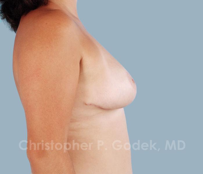 Breast Reduction Before & After Image