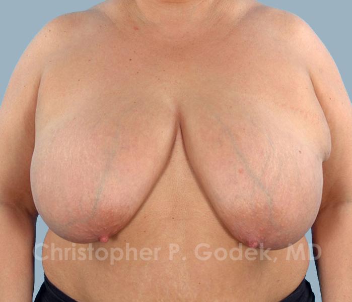 Breast Reduction Before & After Image