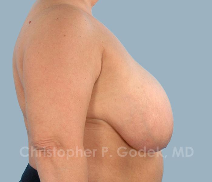 Breast Reduction Before & After Image