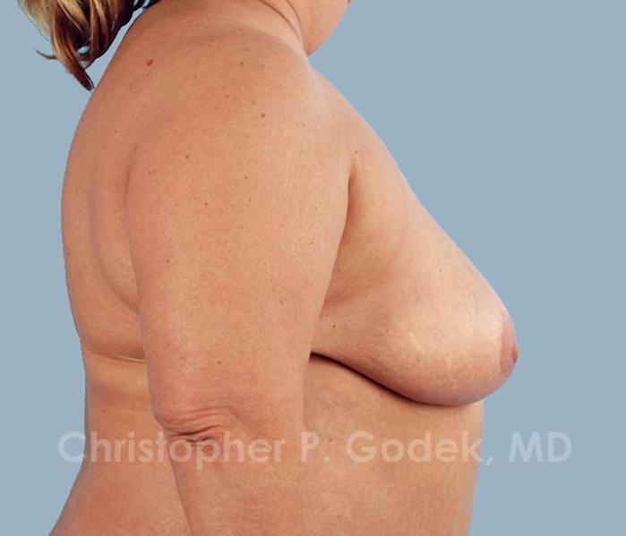 Breast Reduction Before & After Image